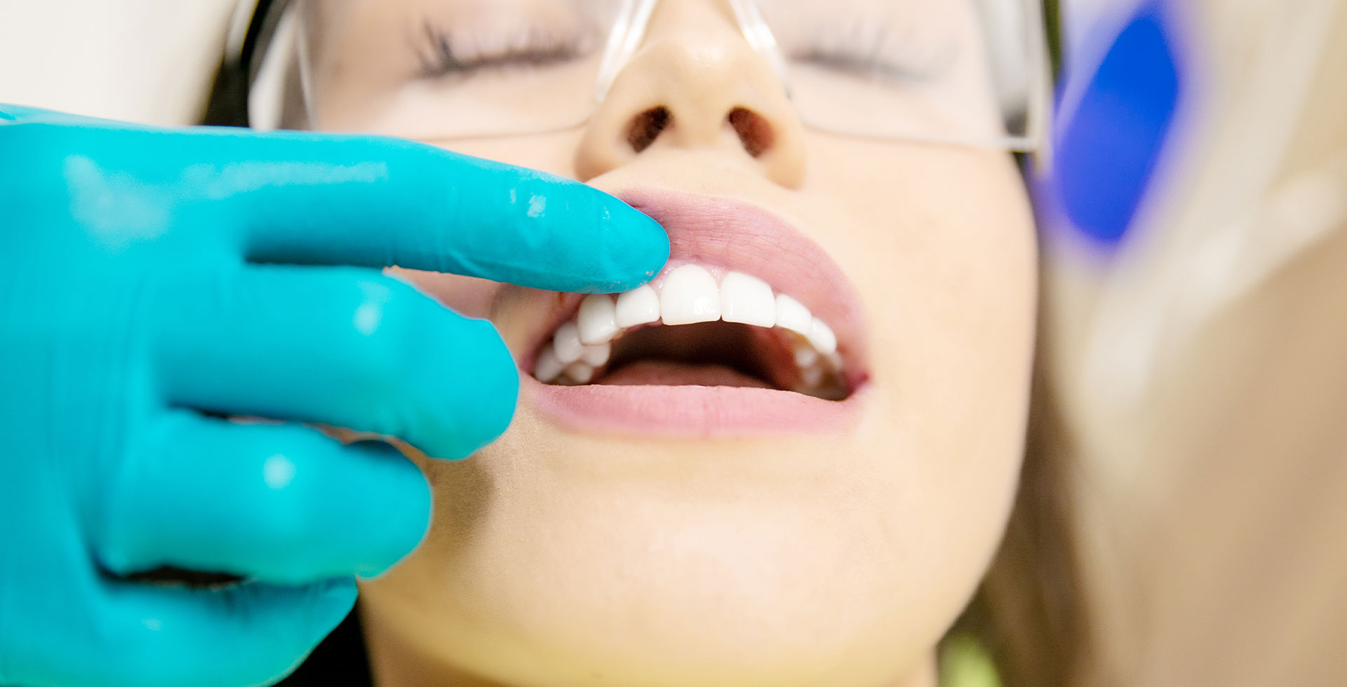 Sbiancamento dentale